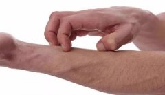 中医学怎样治湿疹？