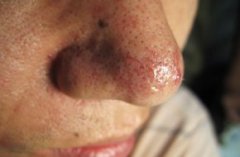 日常如何防范“酒糟鼻”?