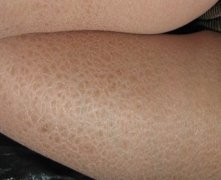 人工荨麻疹有什么常识要了解