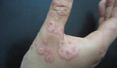 预防皮肤过敏有方法