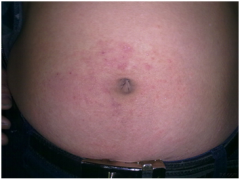 小儿异位性皮炎怎么治疗?