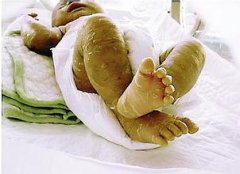 全身鱼鳞病该如何护理