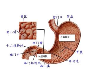 浅表性胃炎用药原则